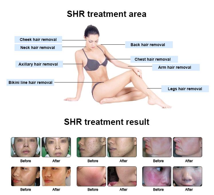 SHR OPCIONAL IPL