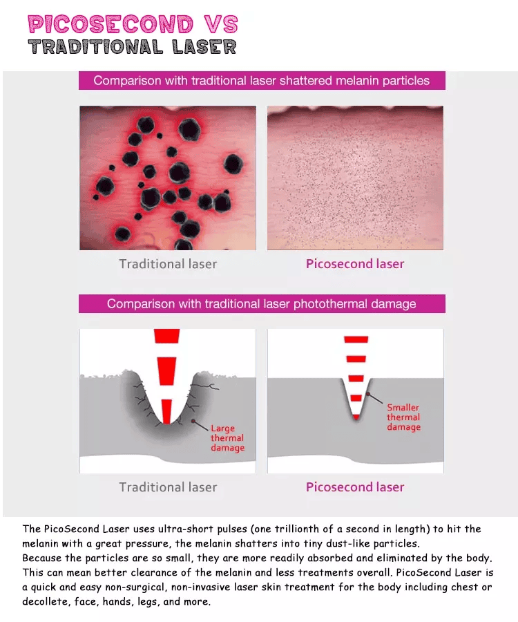 Máquina láser para eliminación de tatuajes Q Switched Nd Yag Laser Machine