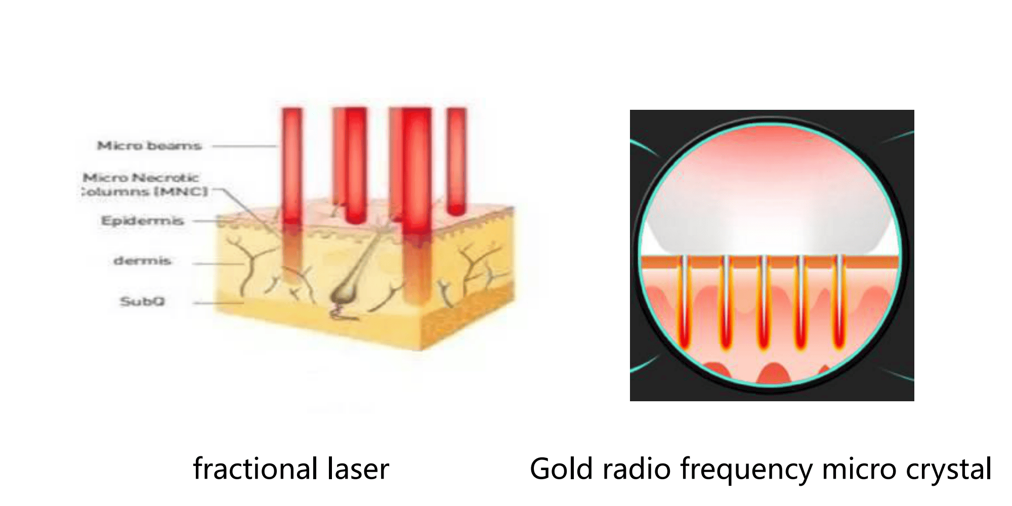 Máquina estacionaria de agujas de microcristales de radiofrecuencia de oro