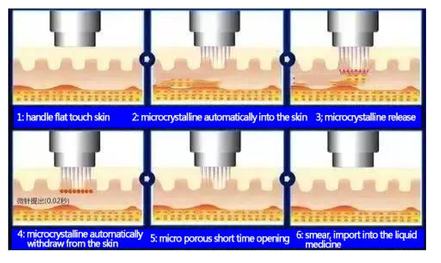 Máquina de aguja de microcristal de radiofrecuencia de oro