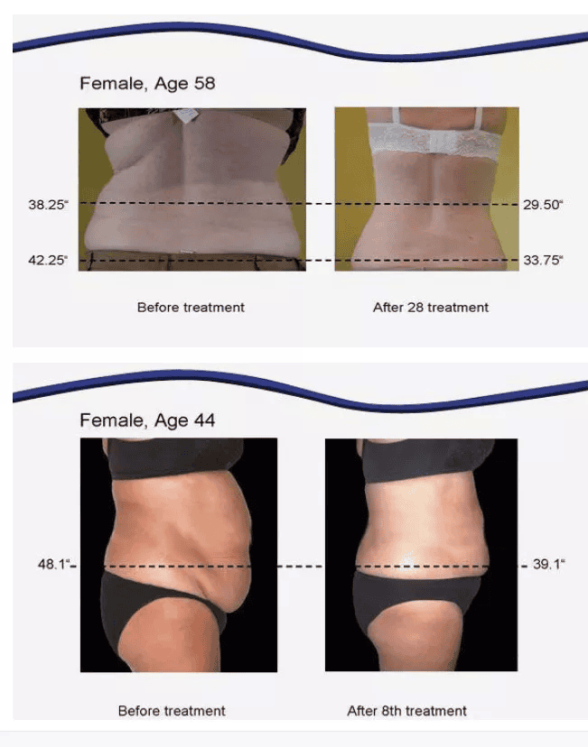 Lipo cavitación celulitis reducción ultrasónica 40K cavitación RF equipo de belleza