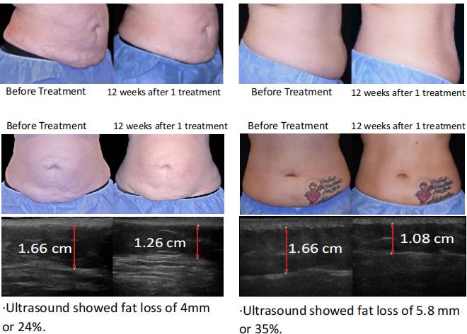 Trusculpt 3d Monopolar Rf Hot Sculpting Grasa Disolución Radiofrecuencia Quema grasa Equipo de contorno corporal